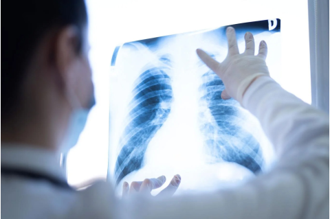  The current standard for lung cancer screenings are low-dose CT (LDCT) scans, and the latest guidelines recommend anyone with a 20-pack-year history of cigarette smoking be screened yearly for lung cancer. Photo: Shutterstock 
