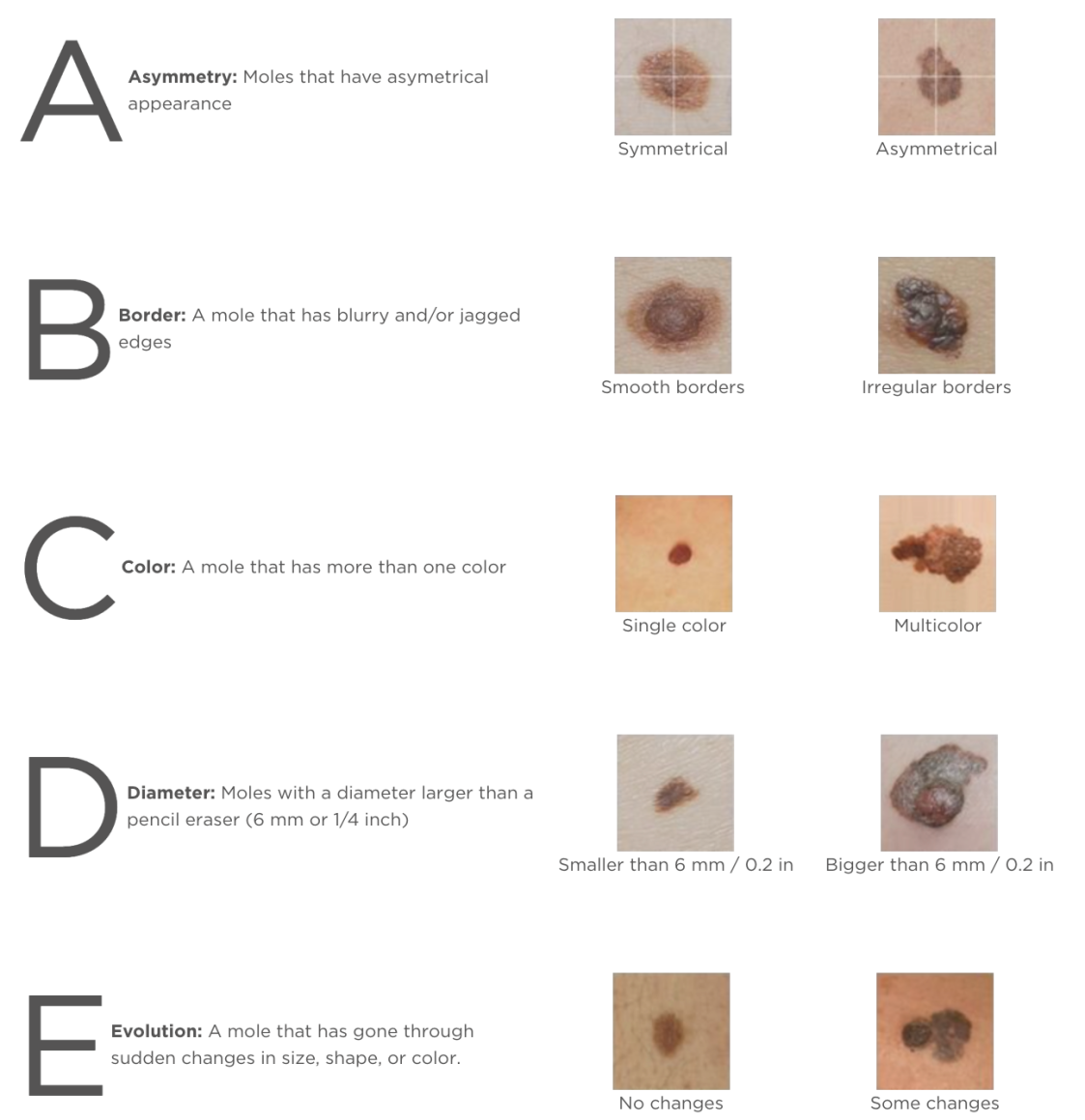 Photos and descriptions of the ABCDEs of Melanoma