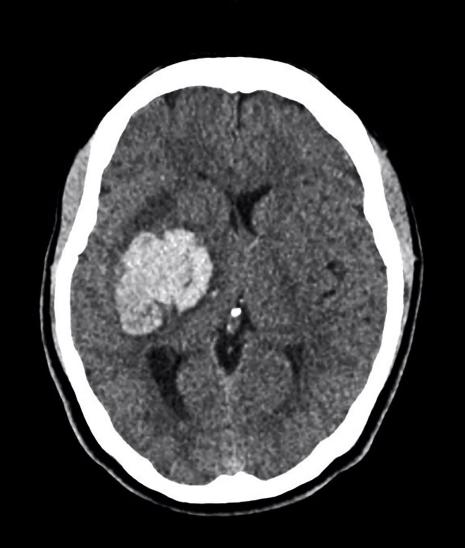 The black area in the center of this CT scan of a brain is evidence of an ischemic stroke. Photo: Shutterstock