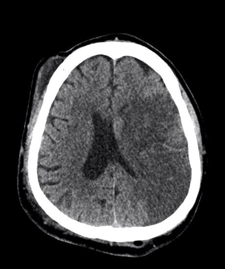 The black area in the center of this CT scan of a brain is evidence of an ischemic stroke. Photo: Shutterstock