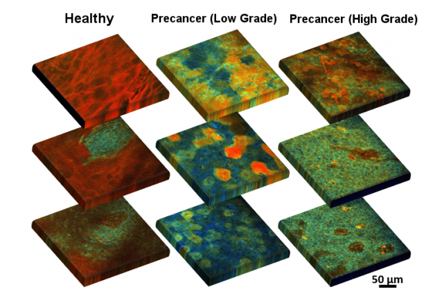 Optical fluorescence scans of excised healthy and precancerous cervical epithelial tissue