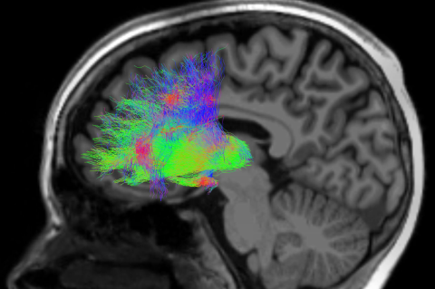 Imaging of the connections between the mediodorsal thalamus and prefrontal cortex in the human brain. 