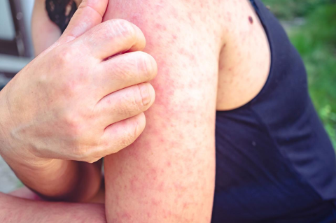 A young woman with the measles itches the rash on her arm