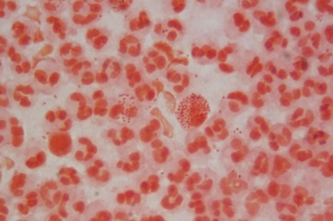 A Gram stain showing the presence of Neisseria gonorrhorae 